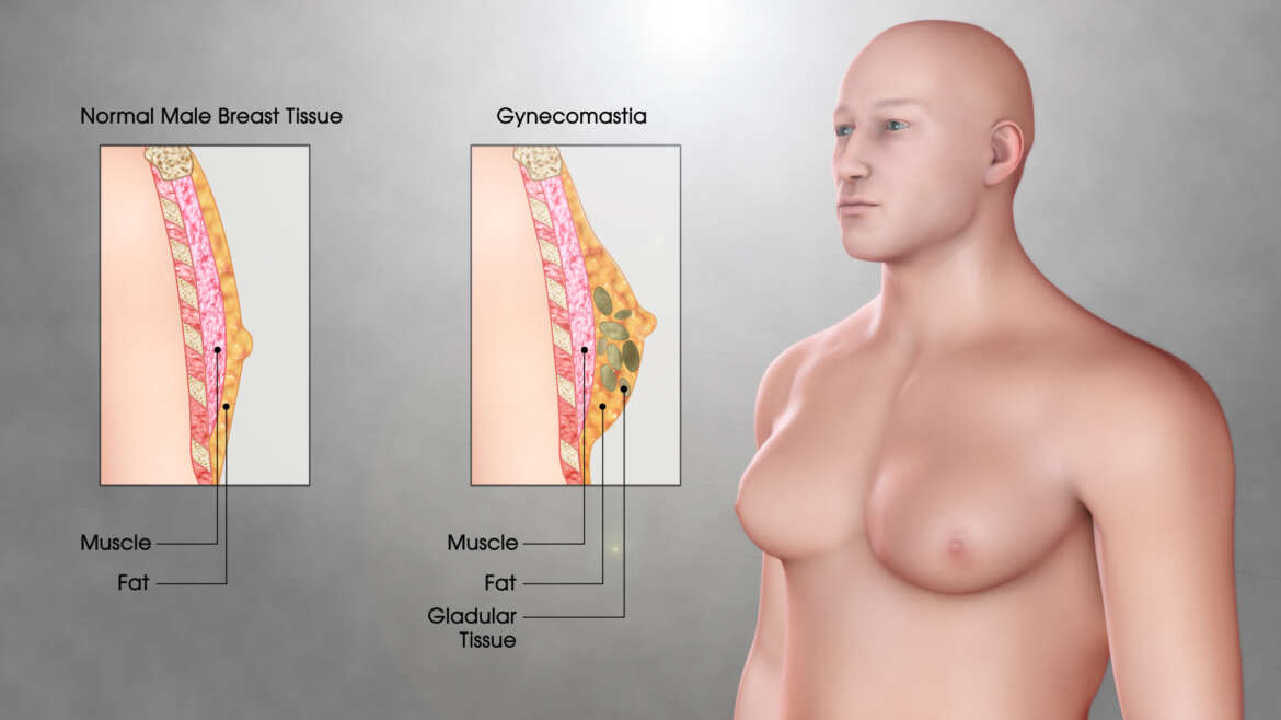 Gynecomastia