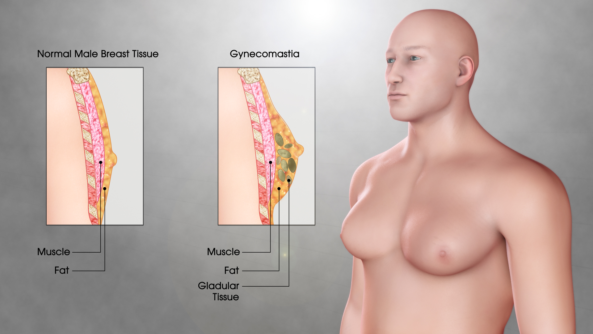 Gynecomastia