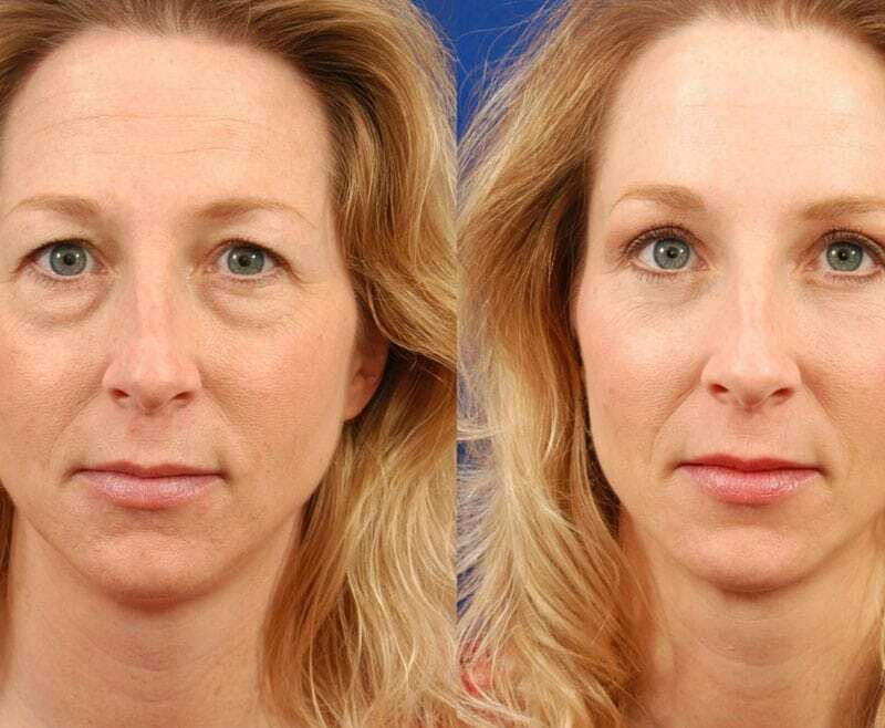 Eyelid Surgery