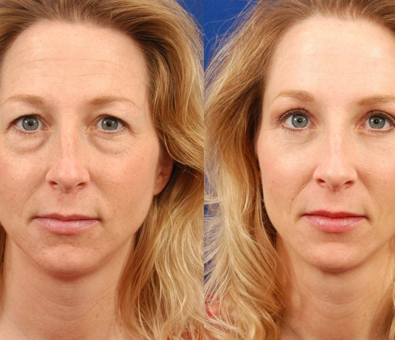 Eyelid Surgery