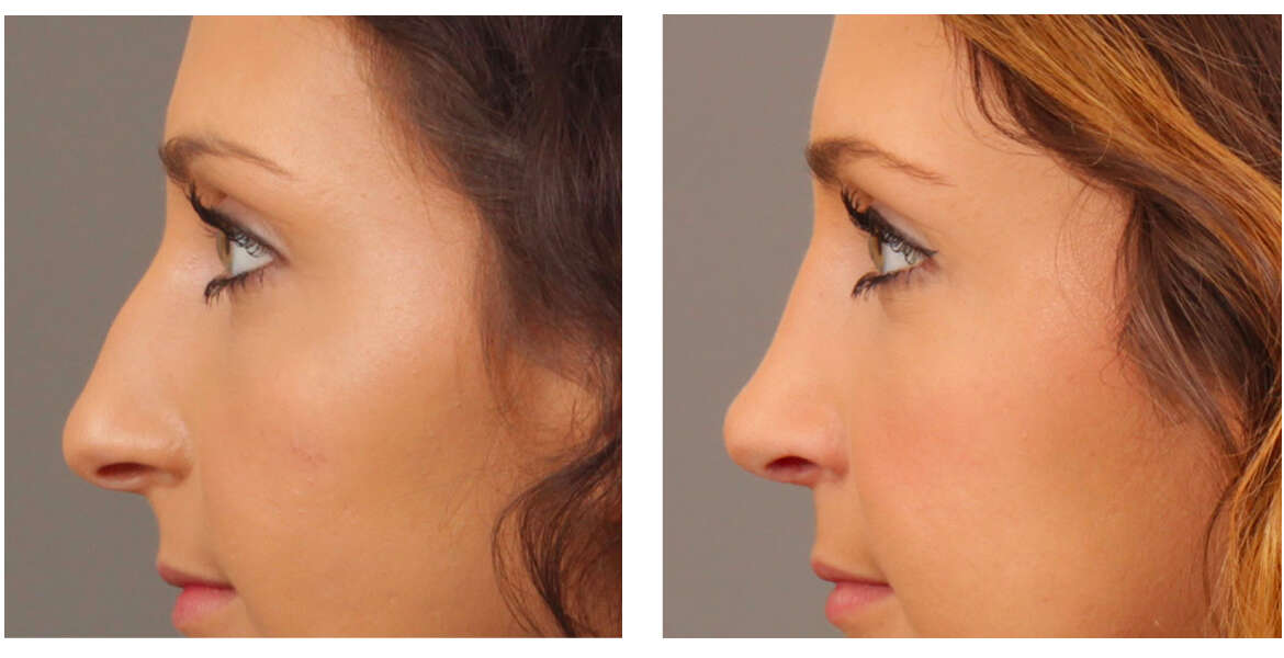 Rhinoplasty