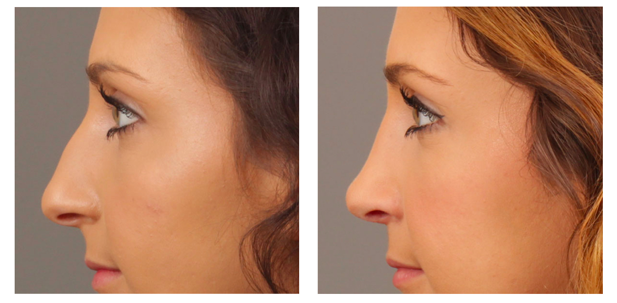 Rhinoplasty