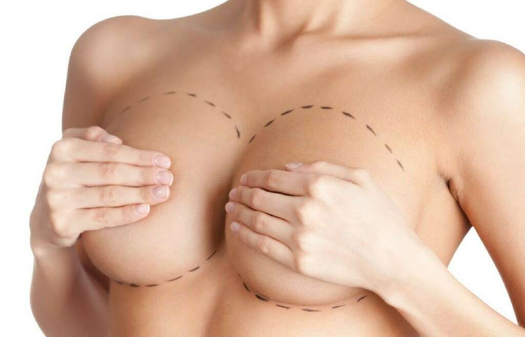 Breast Lift