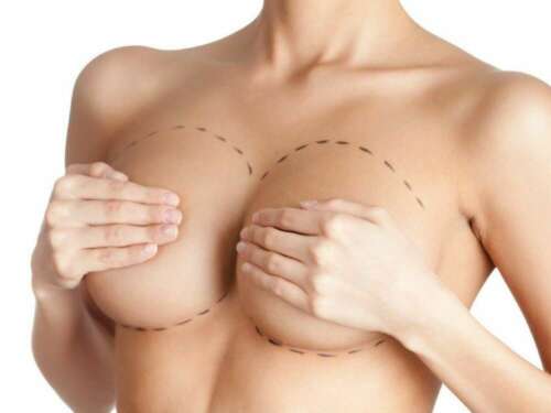 The fuller look breast augmentation